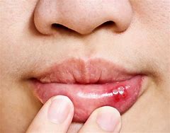 Image result for Blister Inside Mouth