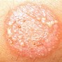 Image result for Circle Rash On Skin