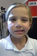 Image result for GBS Facial Palsy