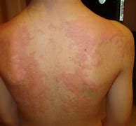 Image result for What Does a Allergic Reaction Rash Look Like