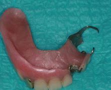 Image result for Partial Dentures Replacement