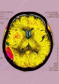 Image result for Real Brain Tumor