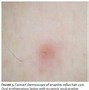 Image result for Eruptive Vellus Hair Cysts to Steotocystoma