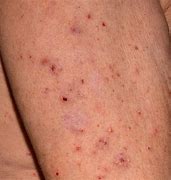 Image result for Scabies Chest