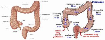 Image result for 35 Cm of Colon