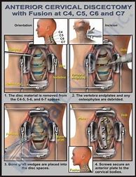 Image result for C5 C6 Disc Replacement Surgery