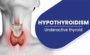 Image result for Underactive Thyroid Treatment