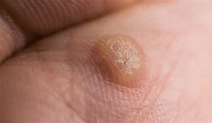 Image result for Wart On Knuckle of Finger