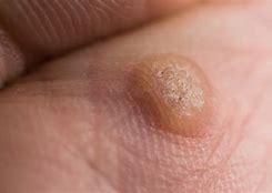 Image result for Common Warts