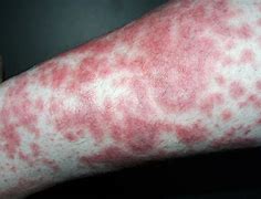 Image result for Diabetic Rash