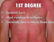 Image result for Third-Degree Skin Burn