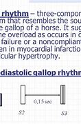 Image result for Diastolic Gallop
