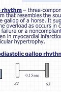 Image result for Gallop Rhythm Cardiology