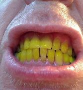Image result for Bad Yellow Teeth