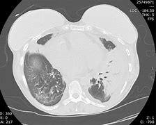 Image result for CT Scan of Valley Fever in Lung