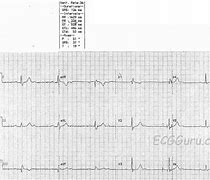 Image result for 2nd Degree Heart Block Type 1 vs 2
