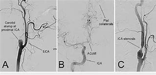 Image result for Left Internal Carotid Artery Angioplasty