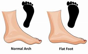 Image result for Flat Feet Posture