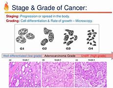 Image result for Tumor Grade