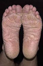 Image result for Moccasin Athlete's Foot