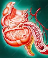 Image result for Small Bowel Crohn's Disease