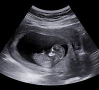 Image result for First Sign of Early Pregnancy