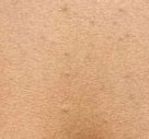 Image result for Eruptive Vellus