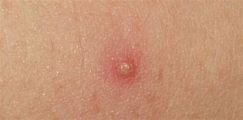Image result for abscezo