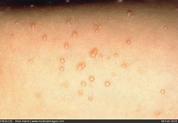 Image result for Molluscum Contagiosum Child