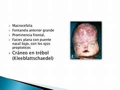 Image result for aconcroplasia