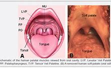 Image result for Papilloma On Soft Palate