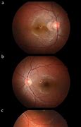 Image result for Retina Cyst