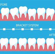 Image result for Protruding Teeth Before and After Braces