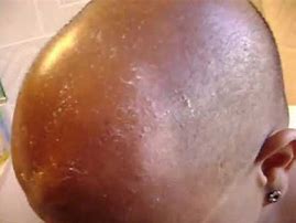 Image result for Sun Burn On Bald Head