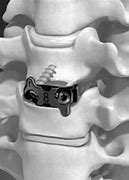 Image result for Cervical Spine Fusion Cage