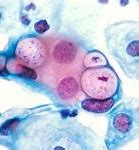 Image result for What Does Chlamydia Look Like