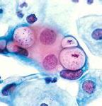 Image result for Chlamydia in Urine