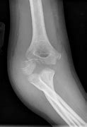 Image result for Lateral Tibial Condyle Fracture