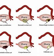 Image result for Physiologic Ovarian Cyst