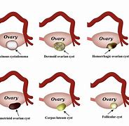 Image result for Pain From Ovarian Cyst
