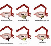 Image result for Pregnancy Cyst Ovary