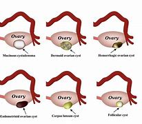 Image result for Ovarian Cyst Symptoms in Women