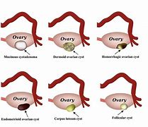 Image result for Ovarian Cyst Diagnosis