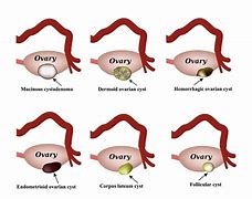 Image result for Endometrial Cyst Size Chart