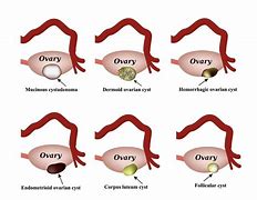 Image result for Cyst in Ovaries