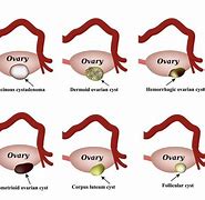 Image result for Ovary Cyst Size