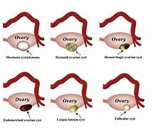 Image result for Cancerous Ovarian Cyst