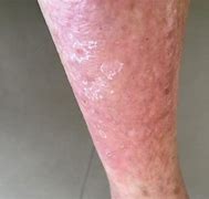 Image result for Metformin Allergy Rash