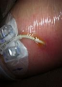 Image result for Infected PICC Line