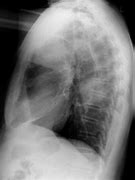 Image result for 2 Cm Nodule On Lung